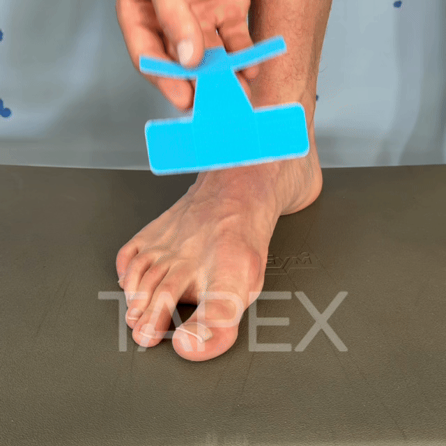 TAPEX™ - Hallux-Valgus