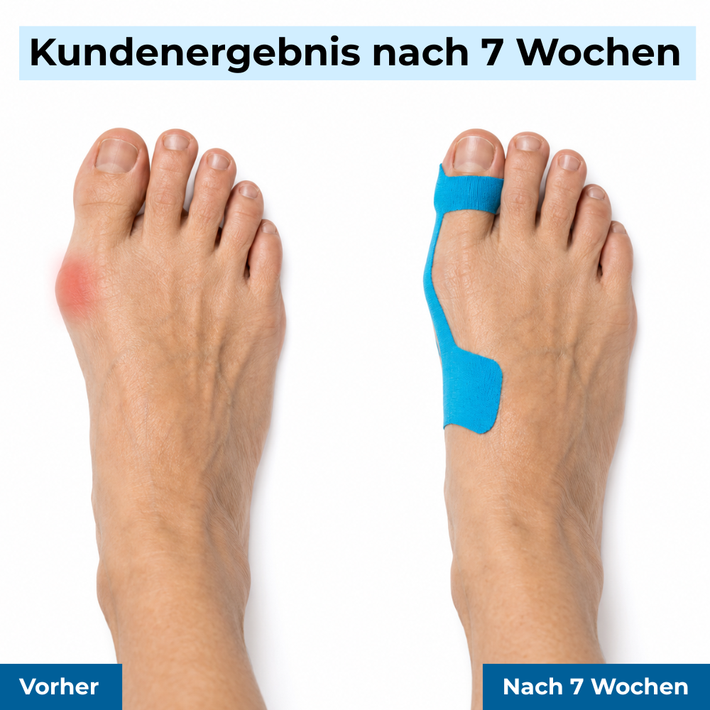 TAPEX™ - Hallux-Valgus