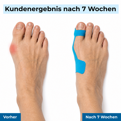 TAPEX™ - Hallux-Valgus