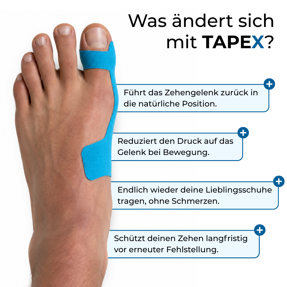 TAPEX™ - Hallux-Valgus